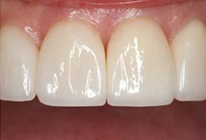 Wainscott Dental | Laser Dentistry, Dentures and Root Canals