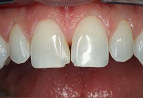 Wainscott Dental | Teeth Whitening, Extractions and All-On-X